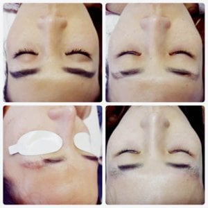  microblading removal for Asian client